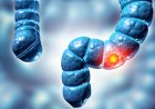 Study finds two types of colon polyps can raise bowel cancer risk fivefold
