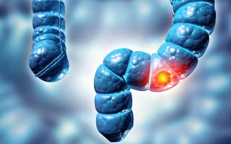 Study finds two types of colon polyps can raise bowel cancer risk fivefold